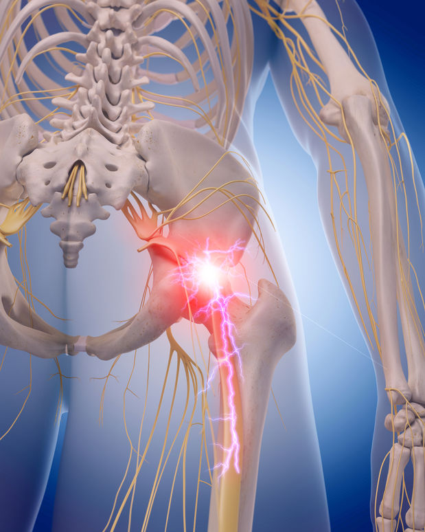 Sciatics Low Back Pain